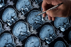 "Cientistas se Aproximam de Desvendar Como o Alzheimer Afecta Neurónios"