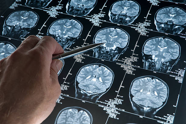 I.A. Identifica Genes do Alzheimer com Mais de 90% de Precisão em Exames Cerebrais